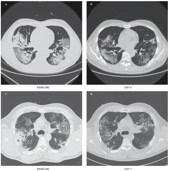 Bevacizumab treatment beneficial for patients with severe COVID-19